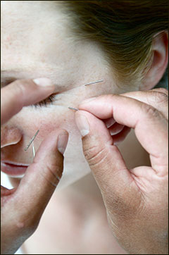 acupuncture in frome